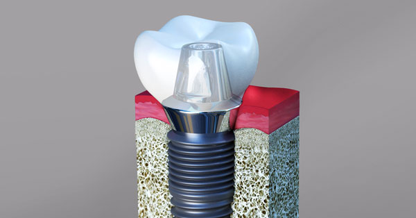 Dental Implants Palm Desert