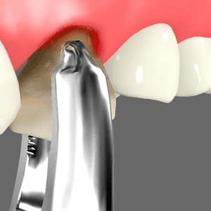 Oral Surgery Rancho Mirage, Palm Desert, Palm Spring, Coachella Valley, Cathedral City, La Quinta, Desert Hot Springs, Yucca Valley, Indian Wells