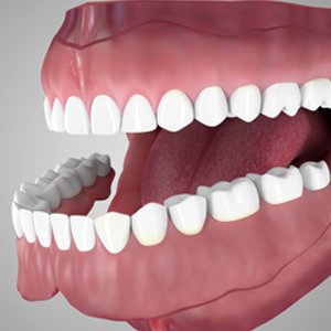 Overdentures supported by tooth root