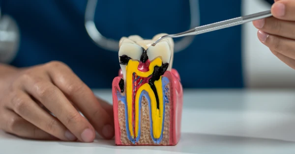 5 Aftercare Tips for Root Canal Treatment in Palm Desert 5 Aftercare Tips for Root Canal Treatment in Palm Desert