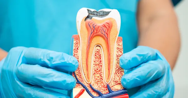 5 Primary Benefits of Root Canal Treatment in La Quinta
