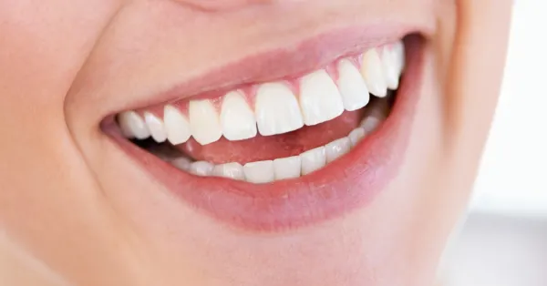 At-Home vs. Professional Teeth Whitening in Palm Desert