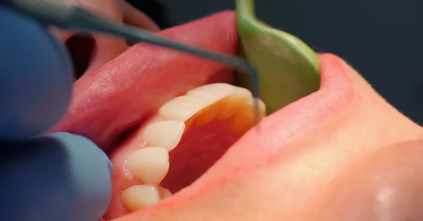 Dentist performing crown lengthening in Palm Springs to expose more tooth structure before placing a dental crown