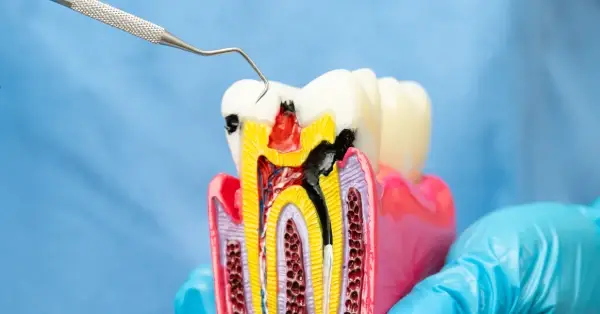 Step-by-Step Process of Root Canal Treatment in Palm Desert Step-by-Step Process of Root Canal Treatment in Palm Desert