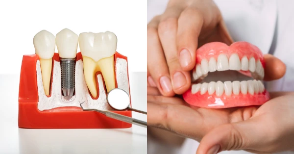 What’s Best: Dentures or Dental Implants in Palm Desert What’s Best: Dentures or Dental Implants in Palm Desert