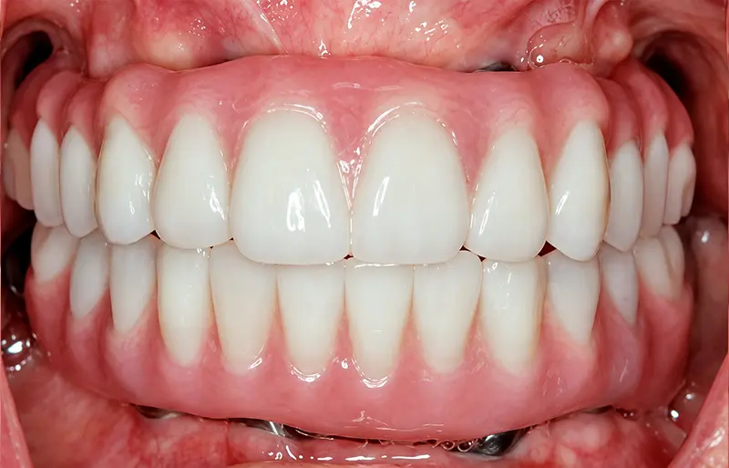 front teeth after implant treatment
