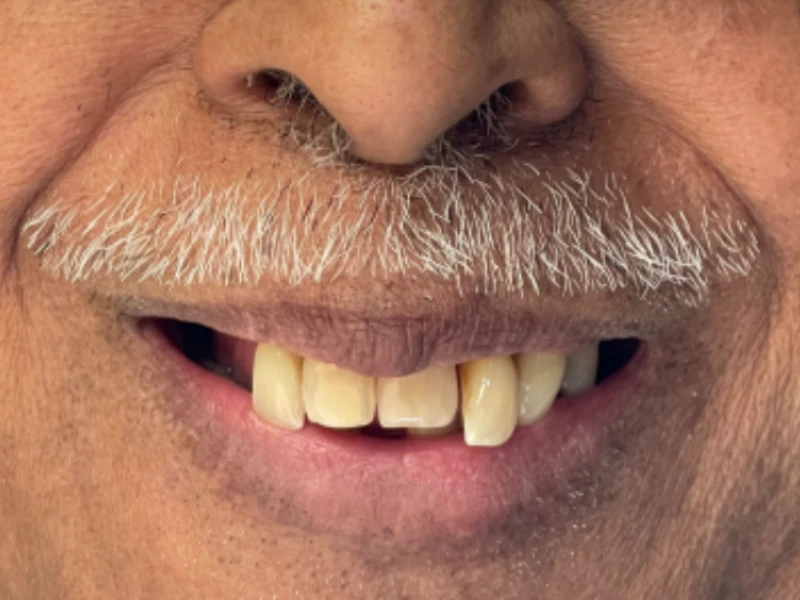 Patient smile before restoration