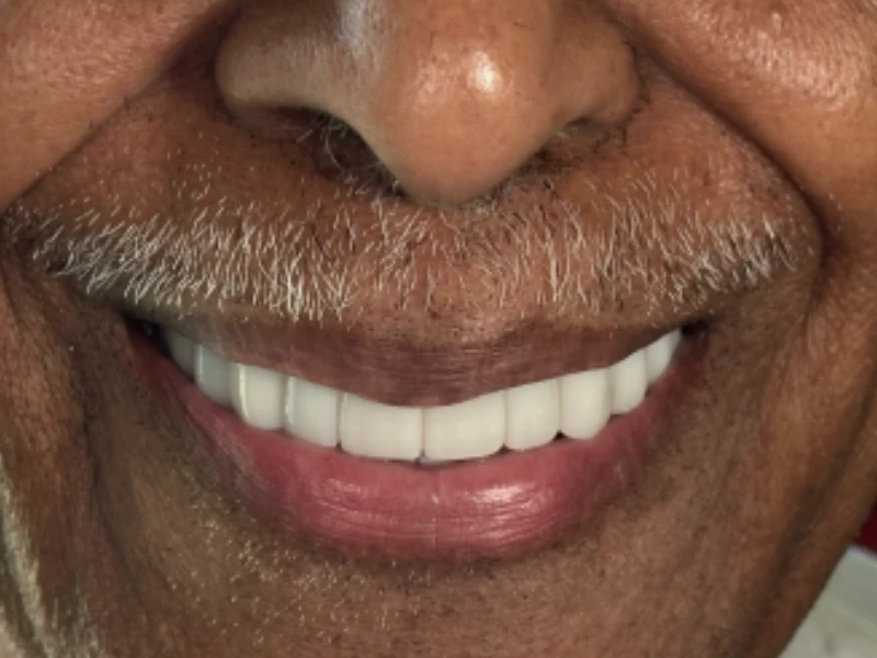 Patient smile after restoration