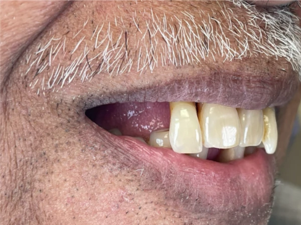 Patient's smile before — failing dental work visible