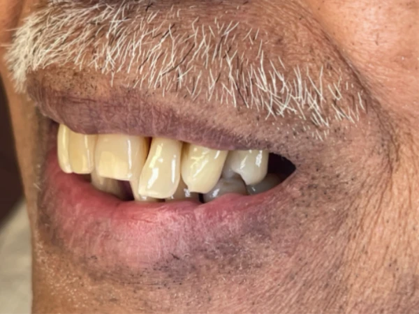 Close-up of failing dental implants and prosthesis