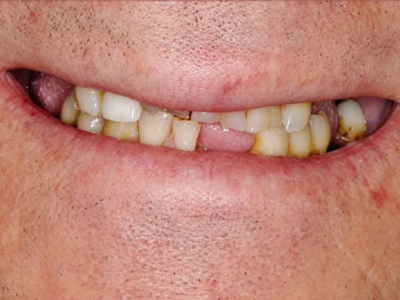 smile before implant treatment