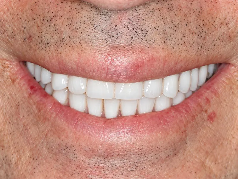 restored smile after implant treatment