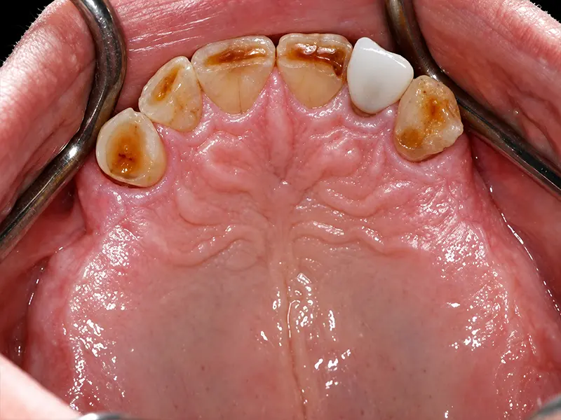 upper arch before treatment