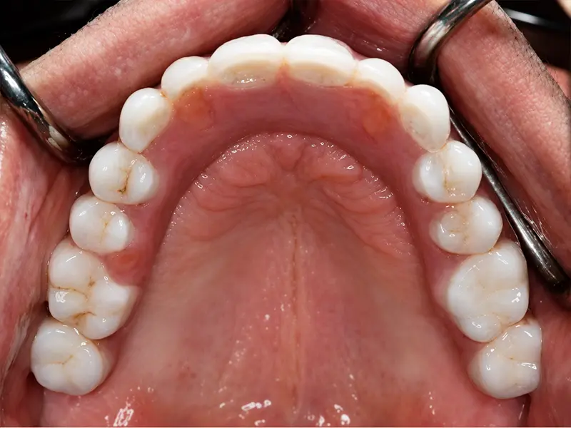 upper arch after implant treatment