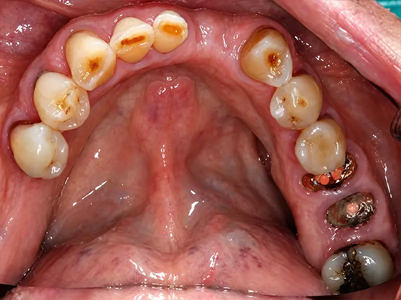 lower arch before treatment