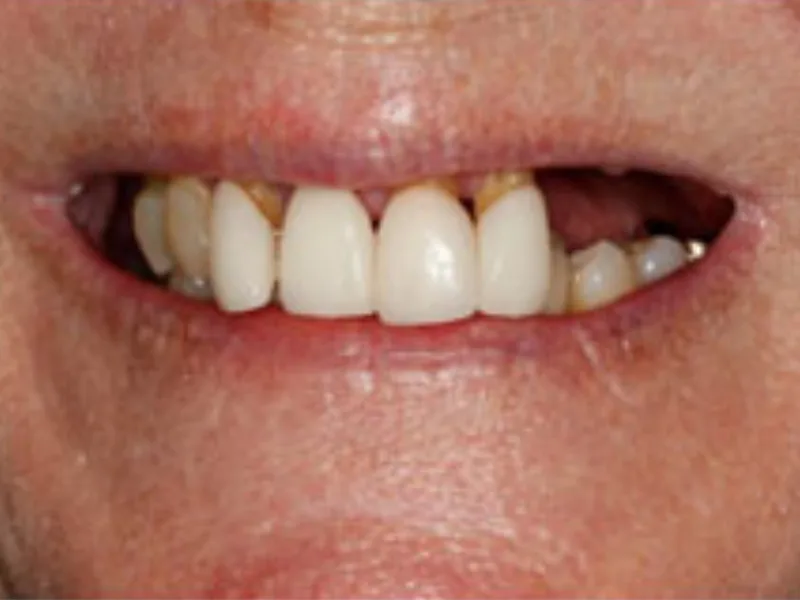 Patient smile before restoration