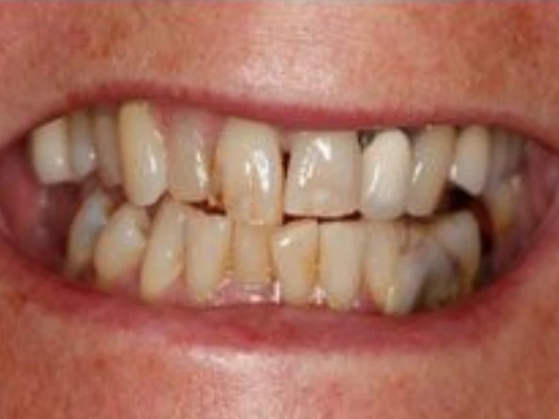 Patient smile before restoration