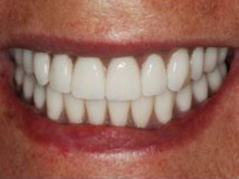 Patient smile after restoration