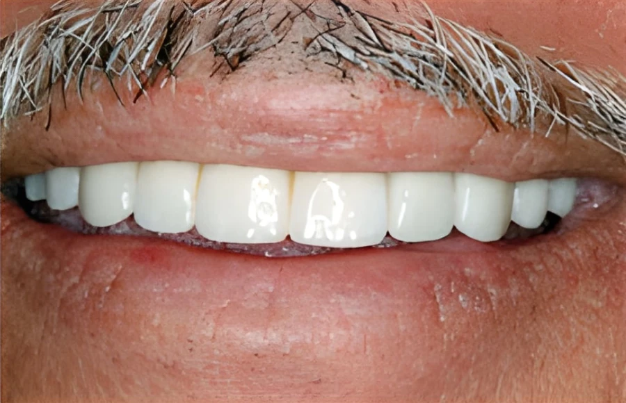 Happy patient with a restored smile