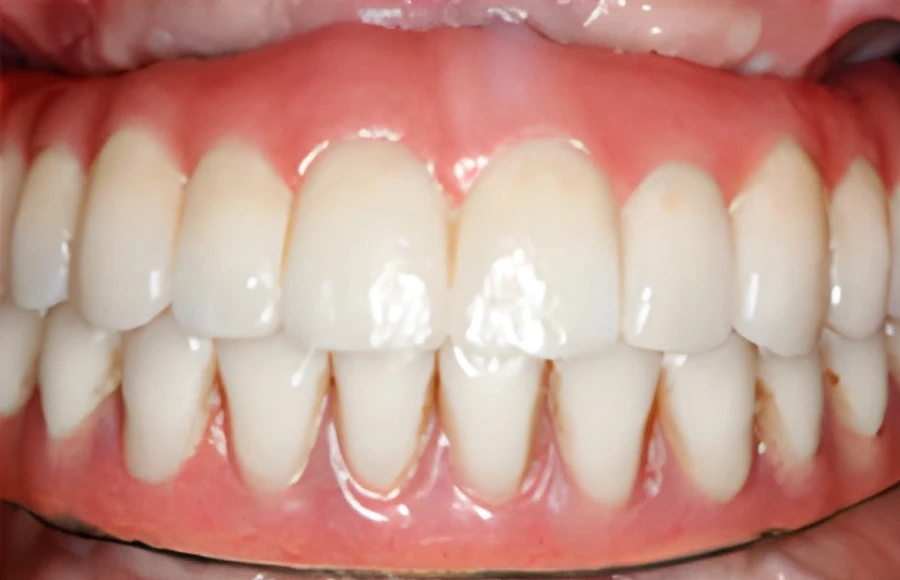 Patient's smile after implant-supported treatment