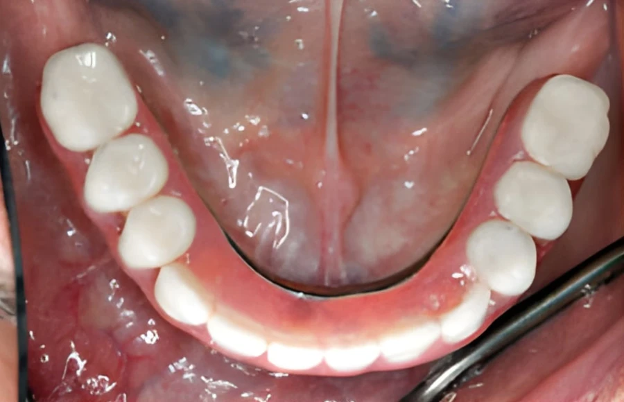 Patient's smile after implant-supported treatment