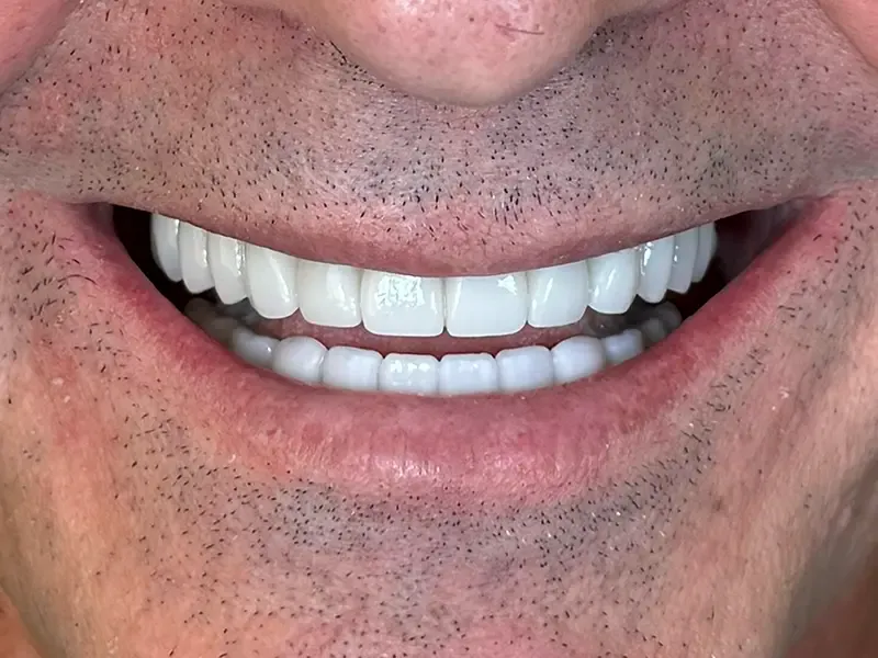 Close-up of the restored smile with natural-looking zirconia bridges
