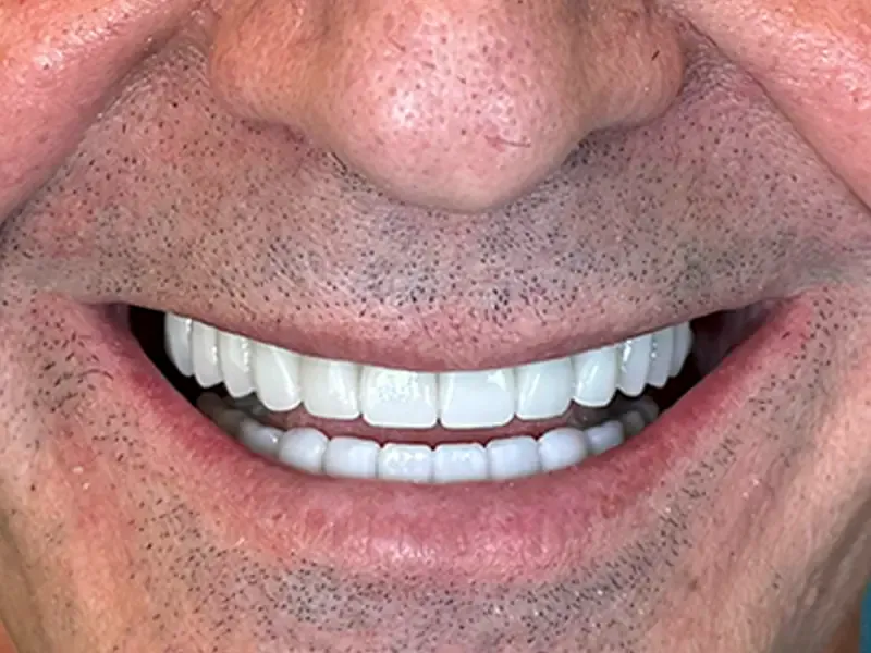Patient smile after restoration