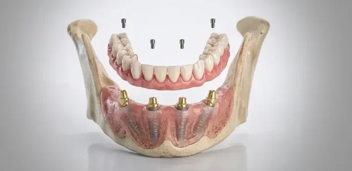 Fixed Implant Restoration