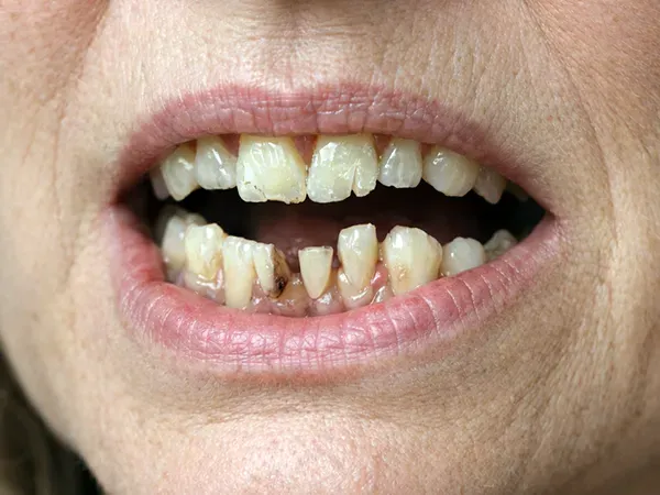 Broken or failing teeth