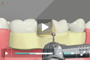 Crown Lengthening(With Bur Tool) - Scenario II