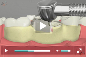 Crown Lengthening(With Laser Tool) - Scenario III