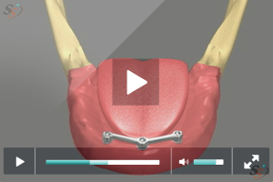 Implant Supported Denture - Scenario 2