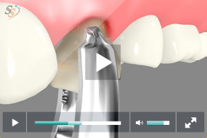 Routine Tooth Extraction