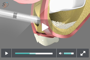 Sinus Grafting in Rancho Mirage, Palm Desert, Palm Spring, Coachella Valley, Cathedral City, La Quinta, Desert Hot Springs, Yucca Valley, Indian Wells