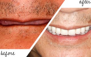 Implants Guru Gallery