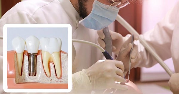 5 Reasons Oral Surgeon Can Fix Dental Implants 5 Reasons Oral Surgeon Can Fix Dental Implants