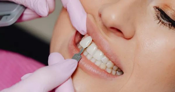 5 Signs You May Need Dental Veneers in La Quinta