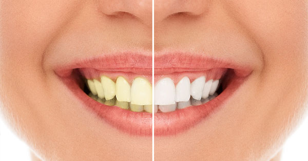 7 Benefits of Teeth Whitening By Cosmetic Dentist | Cathedral City