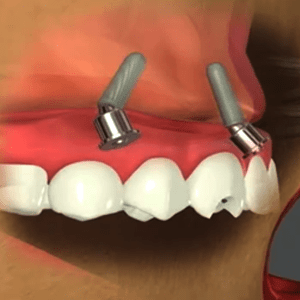 All-on-4 dental implants