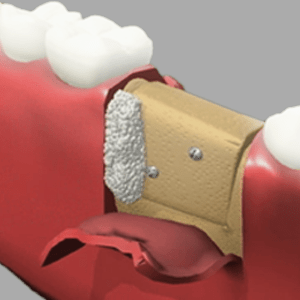 Bone Graft Bone Graft Rancho Mirage, Palm Desert, Palm Spring, Coachella Valley, Cathedral City, La Quinta, Desert Hot Springs, Yucca Valley, Indian Wells