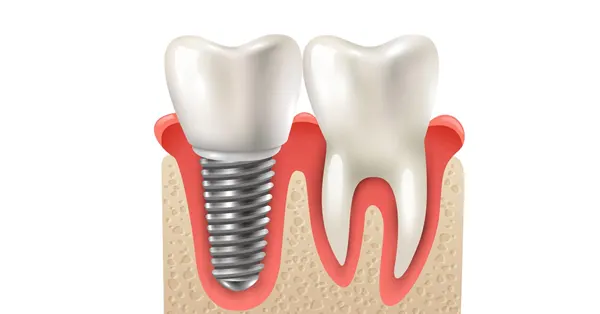The Importance of Choosing a Specialist for Dental Implants in Rancho Mirage