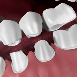 Dental Bridges in Palm Springs