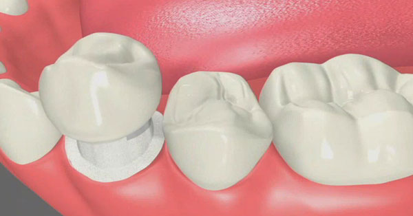 Dental Crowns in Palm Springs