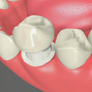 Dental Crowns in Rancho Mirage