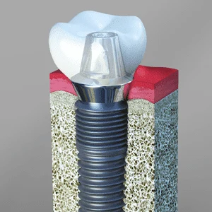 Why are dental implants necessary? Dental Implants