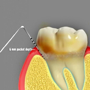 Dental Prophylaxis Rancho Mirage, Palm Desert, Palm Spring, Coachella Valley, Cathedral City, La Quinta, Desert Hot Springs, Yucca Valley, Indian Wells