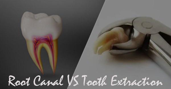 Difference Between Root Canal and Tooth Extraction