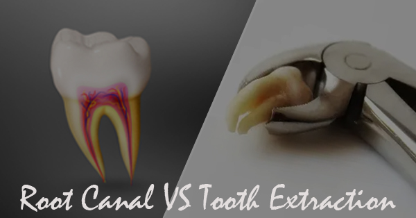 Difference Between Root Canal and Tooth Extraction Difference Between Root Canal and Tooth Extraction