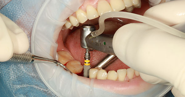 Do You Need Oral Surgeon for Dental Implants