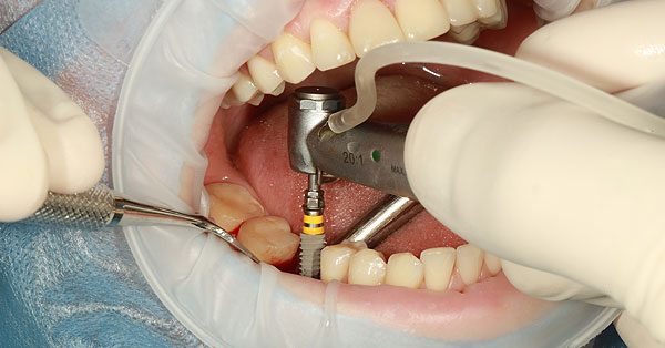 Do You Need Oral Surgeon for Dental Implants 